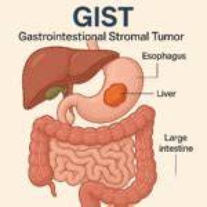 Does gist mean cancer? | ContextResponse.com