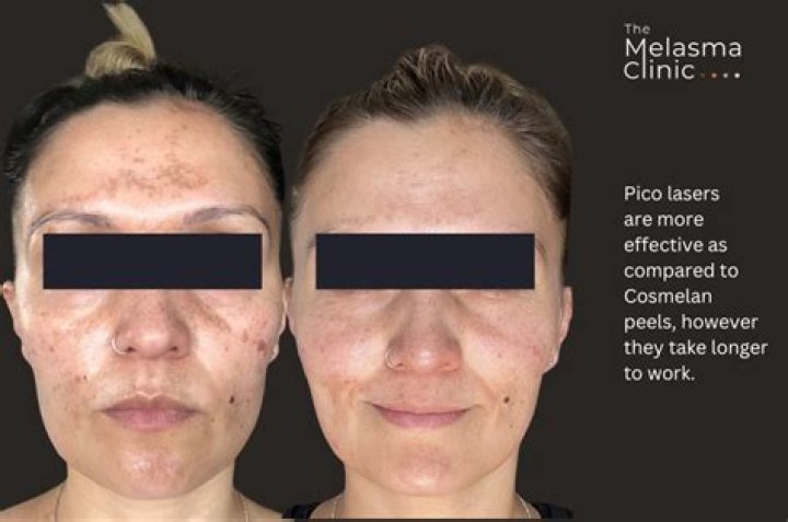Does laser remove melasma?