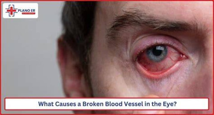 How do you treat a broken blood vessel in your eye?