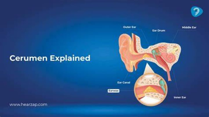 How is cerumen removed? | ContextResponse.com
