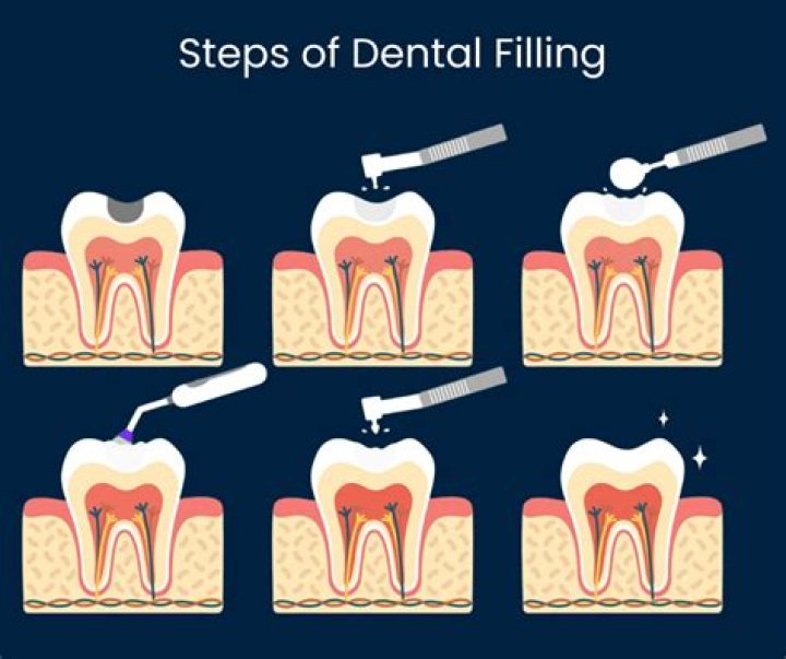 How painful is cavity filling?