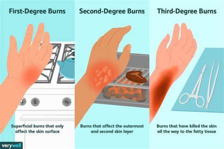What's the worst thing to put on a burn?