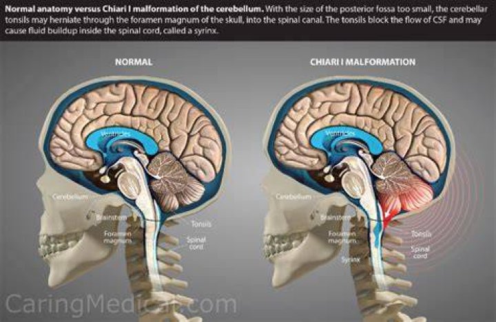What are cerebellar tonsils? | ContextResponse.com