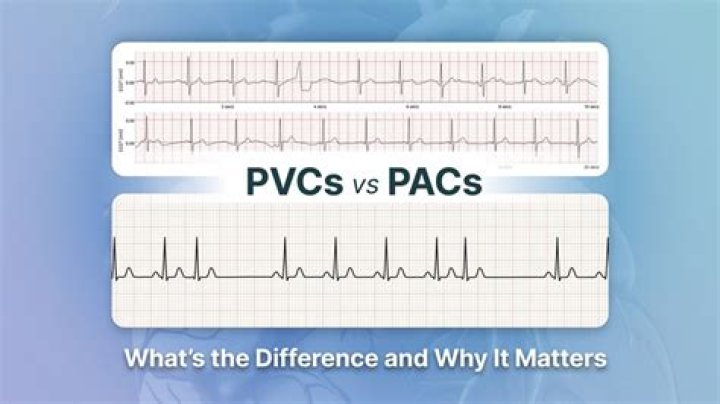 What causes PACs and PVCs?