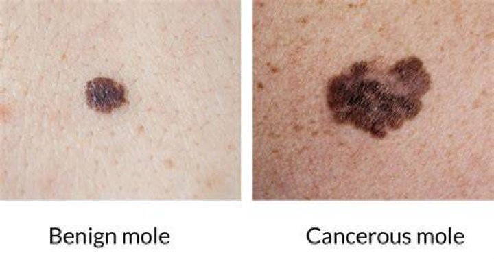 What does cancerous mole look like?