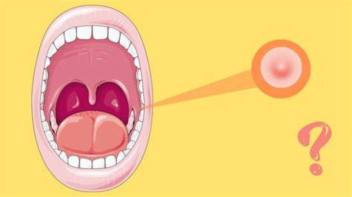 Why do I have a pimple in my mouth?