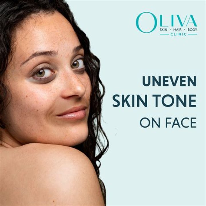 Why does my face have uneven skin tone?