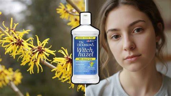 Will witch hazel clear skin?